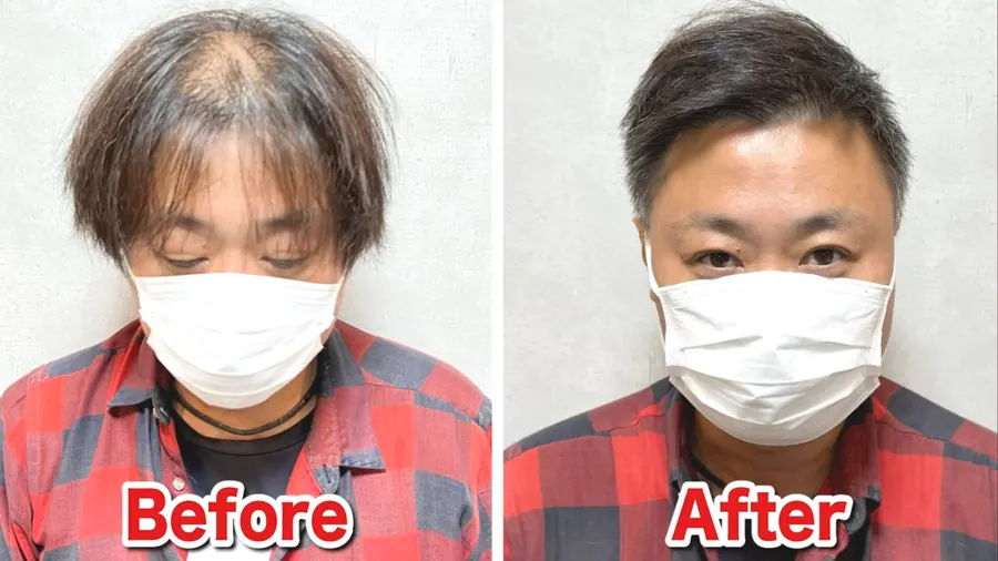 短髮修飾地中海禿的改造案例