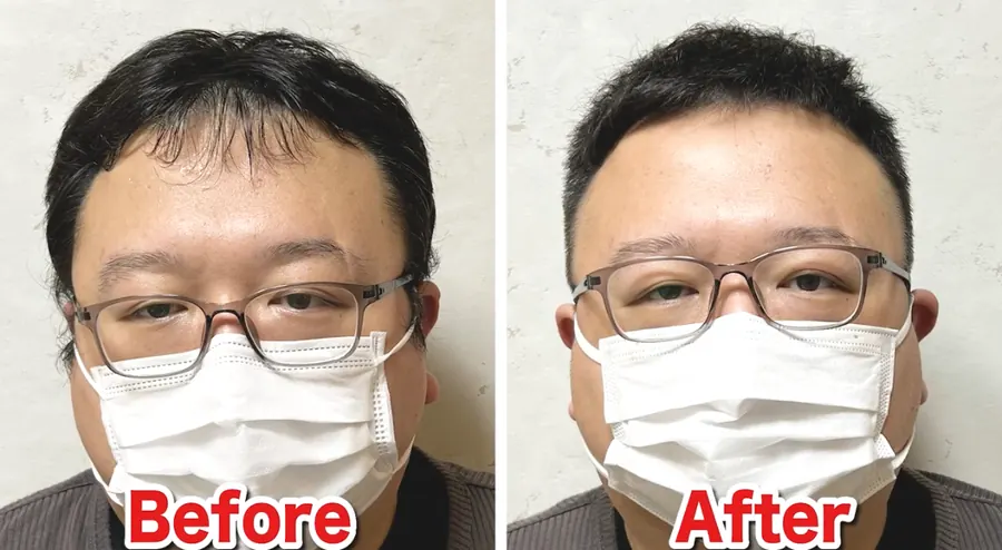 微分碎蓋修飾髮量少