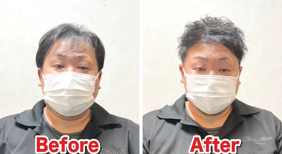 兩側推高修飾M型禿的改造案例