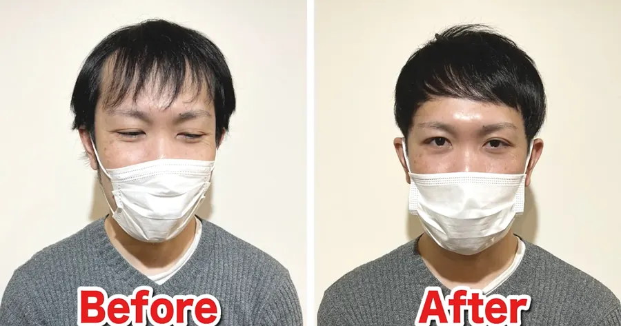 短版蓋頭修飾M型禿的改造案例