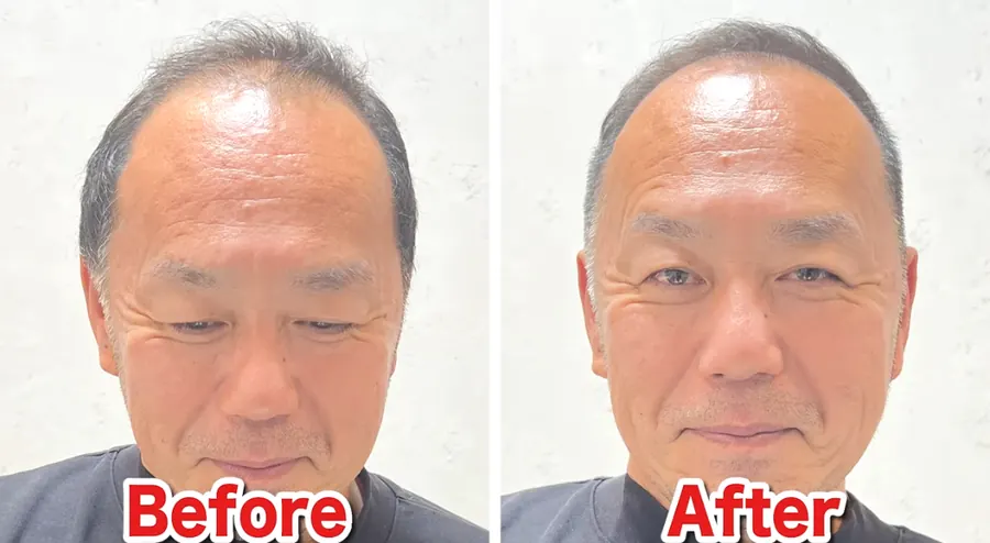 光頭的實際案例