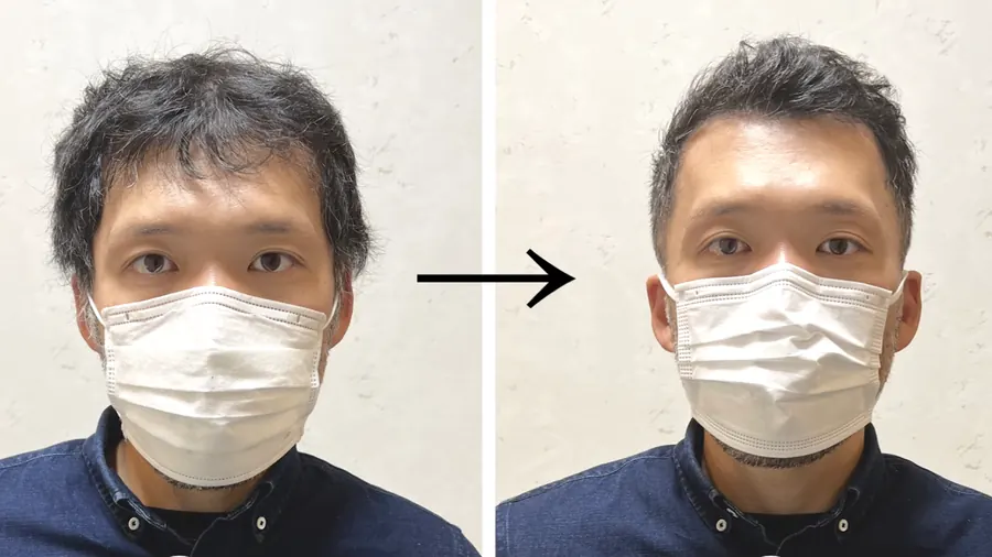 推剪超短髮修飾M型禿的改造案例