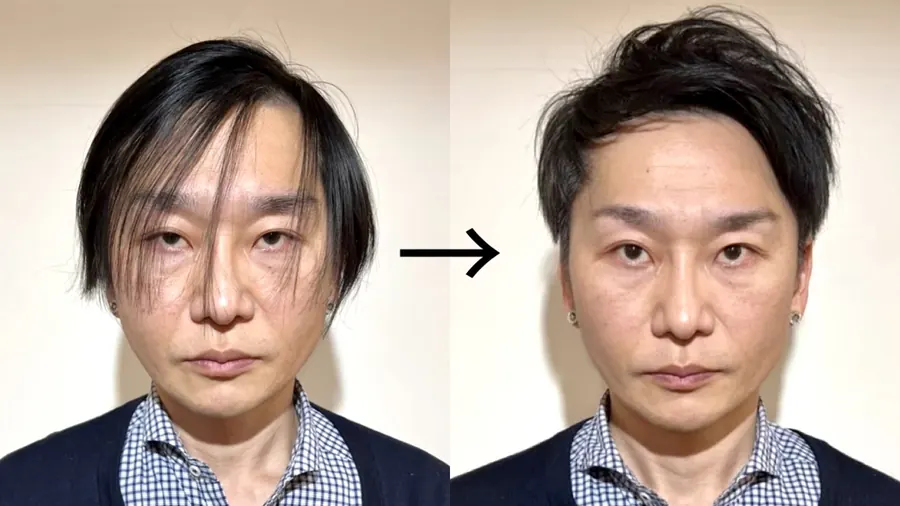 上梳瀏海修飾M型禿的改造案例