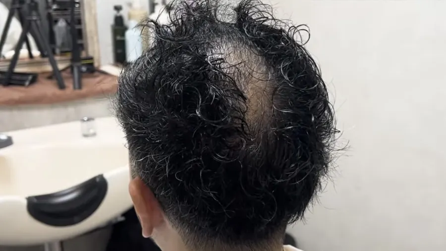 從正上方看髮旋周圍的透光範圍