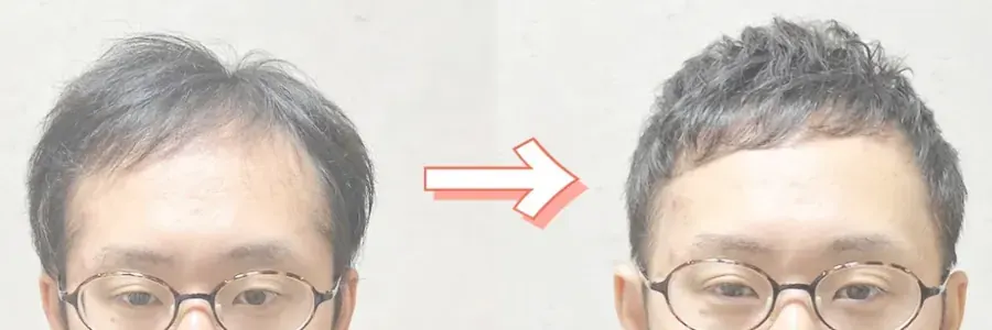 髮量少男士電髮前後對比